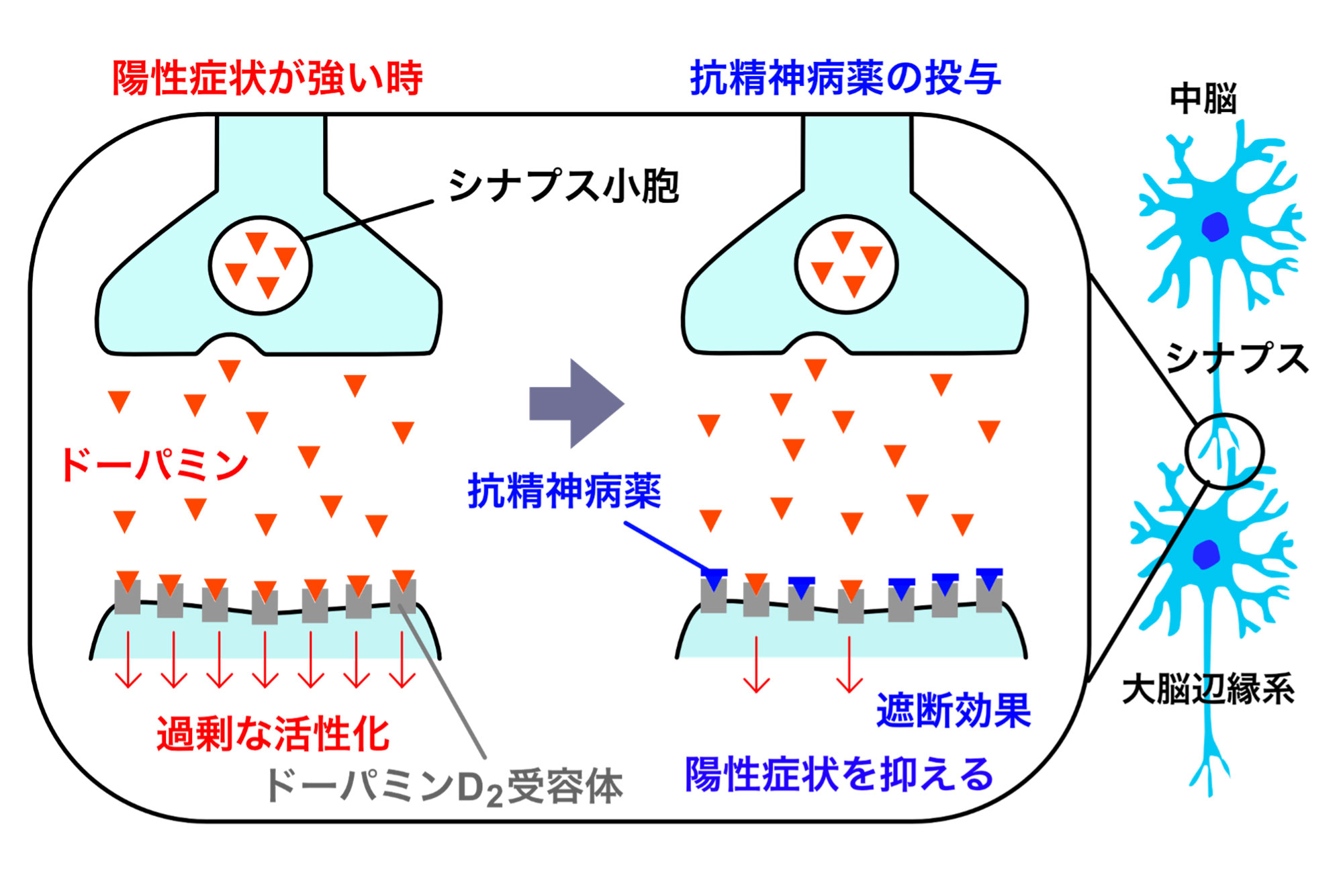 統合失調症の症状